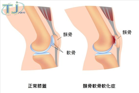 每10名老人2個膝關節退化